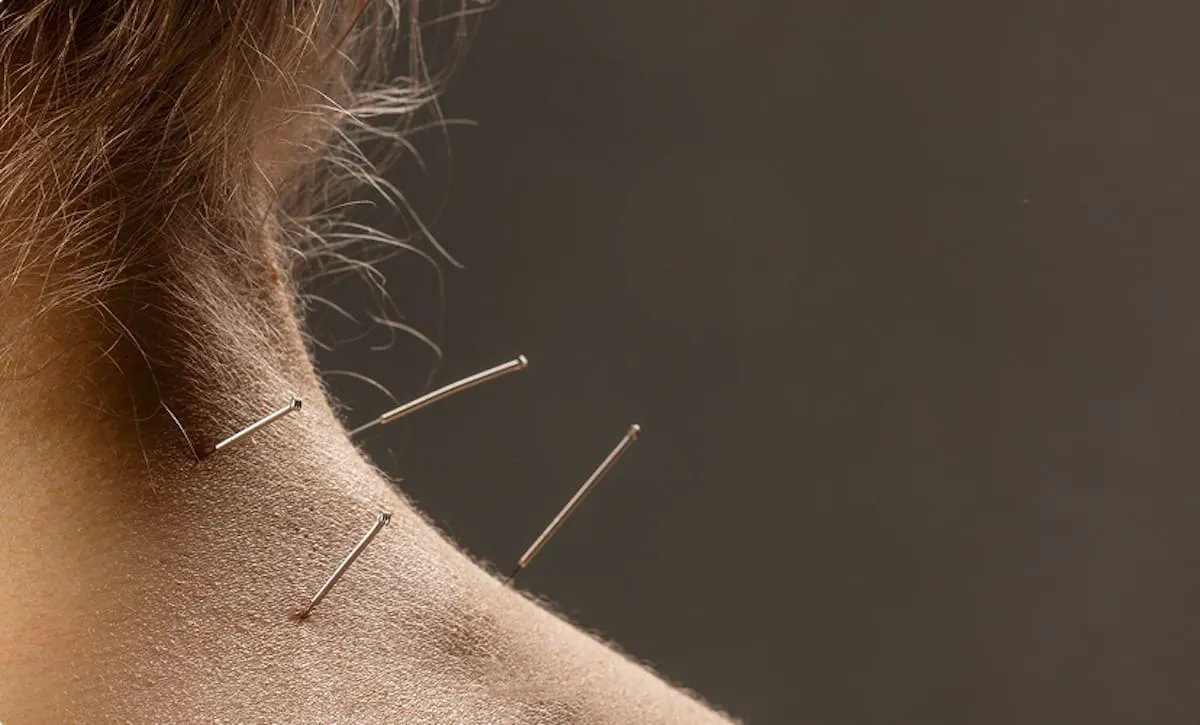 acupuncture-needles-and-treatment-of-body-in-heal